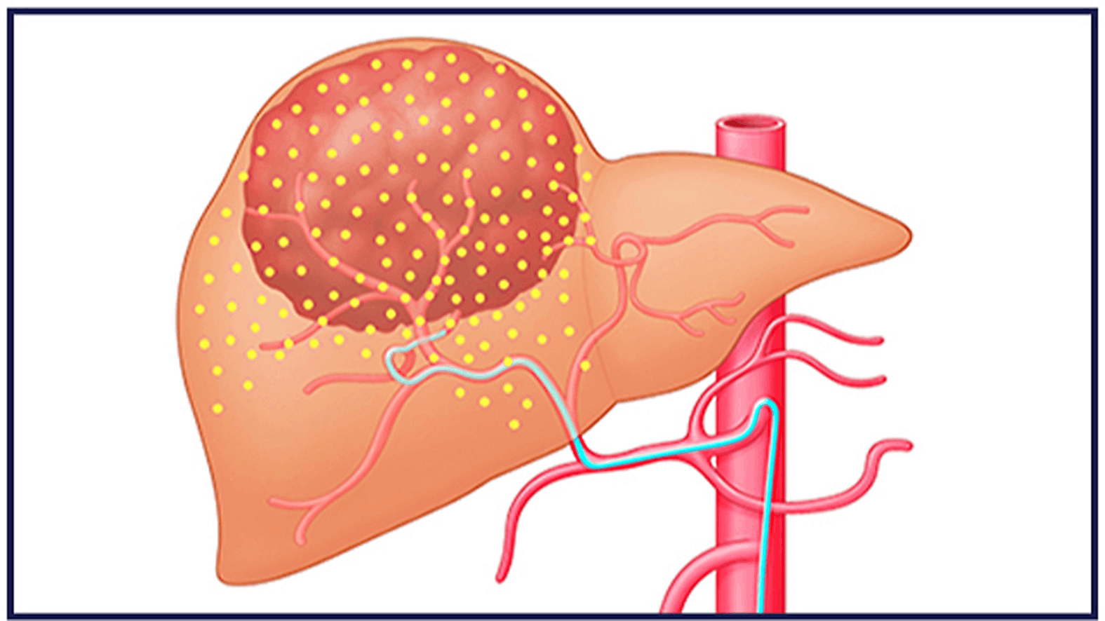 Y-90 Radioembolization (Yttrium-90)